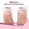 AGARO Callus Remover with 3-Interchangeable-Head-Rollers-Electronic-Foot-Scrubber